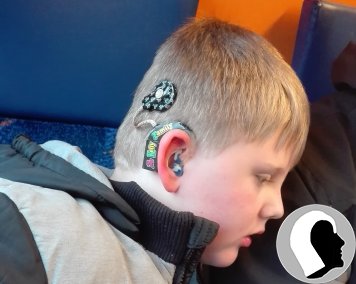 CI Kopf 2018 männlich Kind